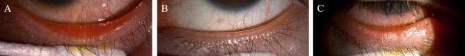 Clinical slit-lamp photographs displaying the classification of Meibomian Gland Dysfunction (MGD) based on lid margin appearance and meibum characteristics. (A) Hypersecretory MGD: Demonstrates significant lid margin hyperemia (redness) and a large volume of expressible meibum (lipid) accumulating along the posterior lid margin, often associated with inflammation. (B) Hyposecretory MGD: Shows a relatively clean, less inflamed eyelid margin with minimal meibum production, characteristic of a low-delivery state. (C) Obstructive MGD: Features an irregular, thickened lid margin with visible plugging of the meibomian gland orifices. Small yellowish mounds or 'capping' may be present at the gland openings, indicating physical obstruction of lipid flow. All three images highlight the relationship between the eyelashes, meibomian gland orifices, and the mucocutaneous junction. These images are educational tools for ophthalmologists and optometrists to differentiate between high-delivery and low-delivery MGD subtypes during physical examination.