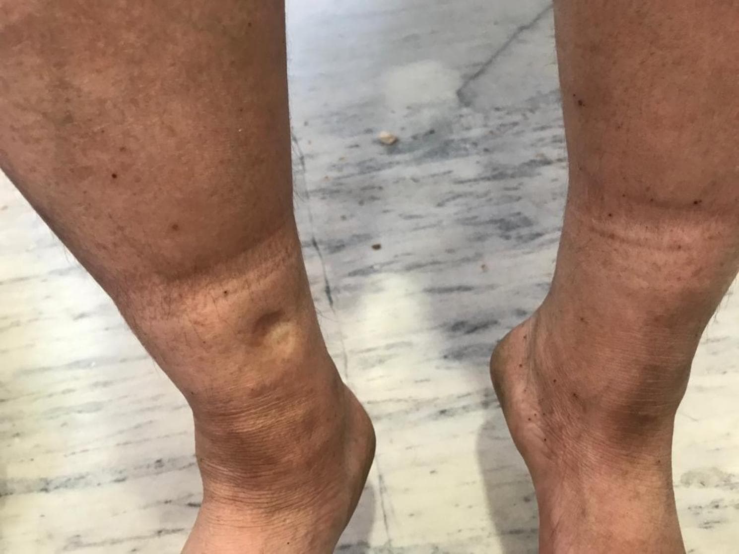 This clinical photograph displays bilateral pedal edema in the lower extremities. The image focuses on the distal legs and ankles, demonstrating significant swelling and tautness of the skin. A key diagnostic feature is visible on the anterior aspect of the lower leg, where a localized indentation or 'pit' remains after pressure was applied, characteristic of pitting edema. The skin shows slight discoloration with scattered hyperpigmented macules and a horizontal band of lighter pigmentation above the malleoli, possibly indicating chronic pressure from footwear or hosiery. The overall presentation is a classic clinical representation used in internal medicine and cardiology to illustrate fluid retention and systemic volume overload. The educational focus is on the assessment of peripheral edema and the visual identification of the 'pitting' sign in a clinical examination context.
