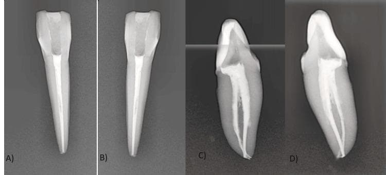 This set of four digital periapical radiographs (labeled A-D) displays an endodontically treated mandibular lateral incisor from multiple projections: A) labial, B) lingual, C) mesial, and D) distal. The images illustrate a complex Vertucci type VII root canal configuration (1-2-1-2). In the labial and lingual views, the obturation appears as a single, uniform radiopaque mass tapering toward the apex. However, the proximal mesial and distal projections reveal a bifurcation into two distinct buccal and lingual canals in the middle third of the root. These canals follow a parallel path before converging and then diverging again in the apical third, forming an apical delta and a lateral canal as visible in D. The obturation material (gutta-percha and resin sealer) shows high radiopacity and adequate apical extent, though slightly shorter in the lingual canal. This visual is used to teach dental students about internal anatomical variations and the importance of multi-angled radiography in identifying complex pulp chamber and canal morphology.