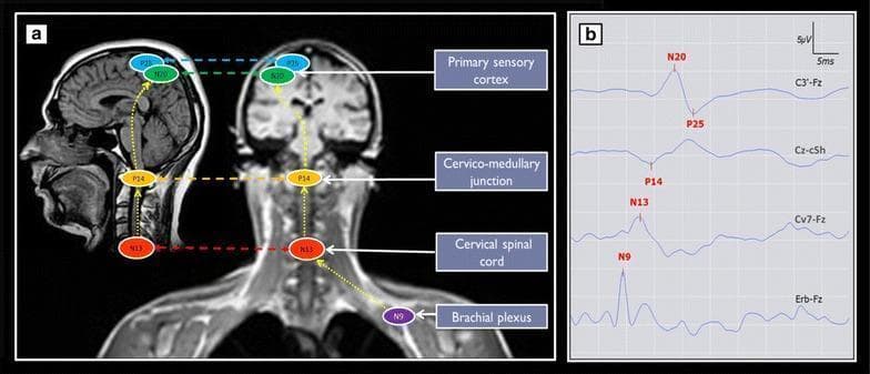 This dual-panel educational graphic illustrates the neuroanatomical origins and typical waveforms of median nerve somatosensory evoked potentials (SSEPs). Panel (a) features sagittal and coronal MRI sections of the head and neck, mapping specific SSEP components to their anatomical generators. Key markers include N9 at the brachial plexus (Erb's point), N13 at the cervical spinal cord, P14 at the cervico-medullary junction, and N20/P25 at the primary sensory cortex. Yellow dashed lines represent the ascending somatosensory pathway from the peripheral nerve to the cortex. Panel (b) displays corresponding normal physiological waveforms across four standard recording montages: Erb-Fz (showing the N9 peak), Cv7-Fz (N13 peak), Cz-cSh (P14 subcortical potential), and C3'-Fz (cortical N20 peak and P25 trough). The graphic provides a clinical correlation between neuroimaging and neurophysiological monitoring, useful for identifying site-specific conduction delays or signal abolishment in neurology and intensive care settings.