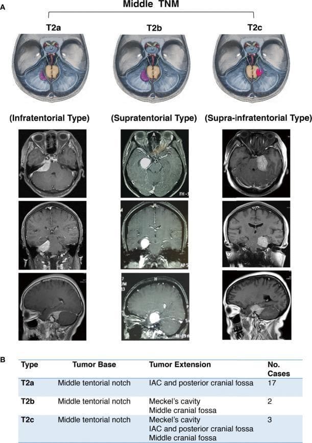 This composite educational image illustrates the classification of middle tentorial notch meningiomas (TNM) into three subtypes: T2a, T2b, and T2c. Section A provides schematic diagrams and T1-weighted axial, coronal, and sagittal MRI scans with gadolinium contrast, highlighting the growth patterns. Type T2a (Infratentorial Type) is shown with a tumor base at the middle tentorial notch extending inferiorly into the internal auditory canal (IAC) and posterior cranial fossa. Type T2b (Supratentorial Type) demonstrates a tumor mass growing superiorly from the tentorium into the middle cranial fossa, often involving Meckel’s cavity, without infratentorial extension. Type T2c (Supra-infratentorial Type) displays a bi-directional growth pattern, with the tumor mass extending both above and below the tentorium, involving the middle and posterior cranial fossae as well as the midline structures. Section B includes a summary table detailing the tumor base at the middle tentorial notch for all types and listing their respective primary extension sites and case frequencies. This resource serves for preoperative surgical planning and neurosurgical classification.