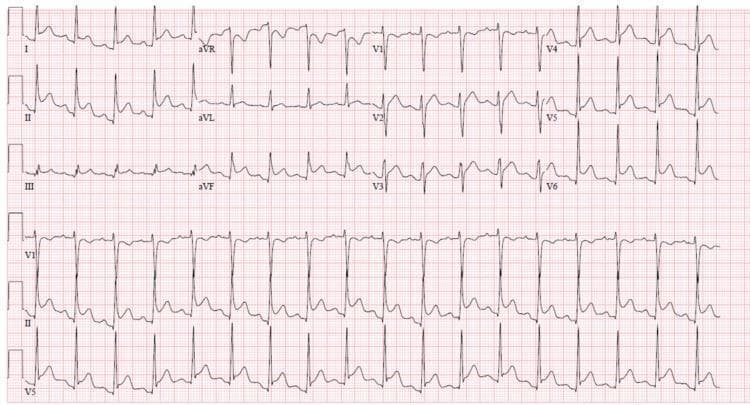 A standard 12-lead electrocardiogram (ECG) demonstrating findings characteristic of acute pericarditis. The tracing shows diffuse, concave 'saddle-shaped' ST-segment elevation across multiple leads, including I, II, III, aVF, and V2 through V6. Conversely, lead aVR displays reciprocal ST-segment depression. A notable diagnostic feature present is PR-segment depression, most clearly visualized in lead II, while lead aVR shows reciprocal PR-segment elevation. Additionally, the TP segments exhibit a subtle downward slope (Spodick's sign) in several leads. The heart rhythm is sinus tachycardia, consistent with a systemic inflammatory process. These combined visual features—diffuse ST elevation and PR segment changes—are classic indicators used to differentiate pericarditis from localized ST-elevation myocardial infarction (STEMI).