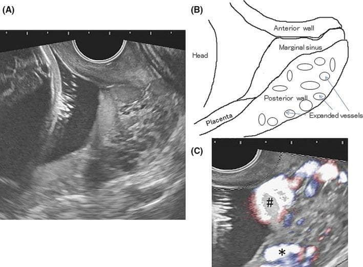 Diagnostic obstetric imaging showing transvaginal ultrasonography (TVS) of the cervical region in three panels. Panel A (B-mode) and the corresponding line diagram in Panel B illustrate an open cervix with low-lying posterior placentation. The placental parenchyma is situated near the internal os but does not occlude it. A key pathological finding is the descent of the placental marginal sinus through the dilated cervical canal towards the external os. Within the posterior cervical wall, multiple enlarged, tortuous vascular structures are identified. Panel C utilizes Color Doppler flow imaging to evaluate hemodynamics; flow is confirmed within the descended marginal sinus (marked with #) and the expanded cervical vessels (marked with *). Crucially, the imaging demonstrates no direct vascular communication between the marginal sinus and the expanded posterior cervical vessels. This case illustrates high-risk third-trimester ultrasound findings related to placental position and abnormal cervical vascularity, which are critical for assessing risks of obstetric hemorrhage.