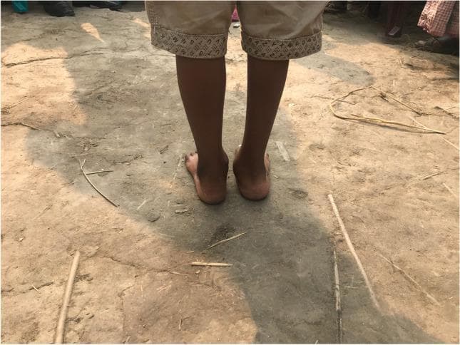Clinical photograph showing a posterior view of the lower legs and feet of a pediatric patient, specifically a 5-year-old boy, two years following a right posterior medial release (PMR) with tibialis anterior tendon transfer (TATT). The image illustrates post-surgical foot alignment and morphology. Key visual findings include a bilateral valgus deformity of the hindfoot, with a more pronounced abduction and eversion on the right side compared to the left. The right medial malleolus appears prominent, indicating weight-bearing distribution favoring the medial aspect. The skin and soft tissues around the ankles appear well-healed without significant scarring, edema, or discoloration, suggesting successful recovery from complex orthopedic intervention for congenital or developmental foot deformity. This visual serves as an educational example of post-operative outcomes in pediatric orthopedic surgery for conditions like clubfoot (talipes equinovarus).