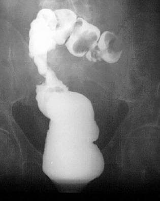 This diagnostic image is an irigography (barium enema radiography) of the colon, demonstrating a significant pathology in the region of the hepatic flexure. The lower segment of the contrast-filled colon appears smooth and normal in caliber. As the contrast ascends, there is a clear transition zone marked by a sudden, severe circumferential constriction (stenosis). Superior to this constriction, the colon exhibits massive dilation and an irregular, lobulated appearance with multiple bulbous segments. The contrast within these dilated lobes shows heterogeneous density, including lucent areas likely representing gas or displacement by a large mass. The morphology is highly suggestive of an obstructing tumor at the hepatic flexure, showing the classic 'apple-core' sign or shelf-like transition typical of malignancy. This image is used in gastroenterology and radiology curricula to teach the visual manifestations of colorectal cancer and the utility of fluoroscopic contrast studies in identifying bowel obstructions and anatomical abnormalities.