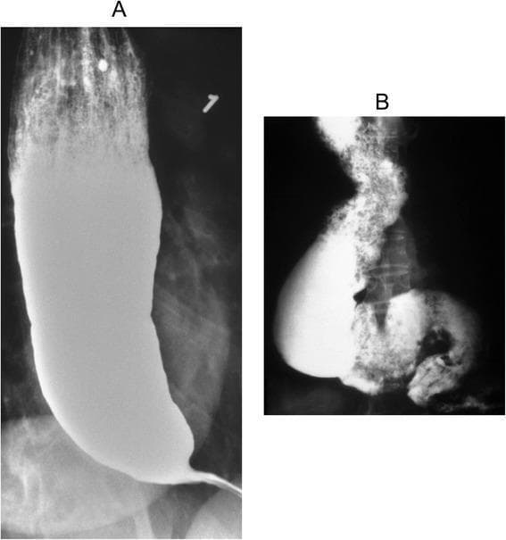 This diagnostic fluoroscopy figure displays two barium swallow (esophagogram) images illustrating the progression of achalasia. Image A shows a classic presentation with significant esophageal dilation and a large column of retained barium. The distal esophagus exhibits a smooth, symmetric tapering toward the gastroesophageal junction, creating the characteristic 'bird's beak' appearance, which indicates failure of the lower esophageal sphincter (LES) to relax. An air-fluid level is visible at the top of the barium column. Image B demonstrates advanced, end-stage achalasia, characterized by a 'sigmoid esophagus.' In this stage, the esophagus is markedly dilated, elongated, and tortuous (deformed). There is a mottled appearance within the barium column caused by a mixture of retained food particles and secretions. These images highlight the loss of primary peristalsis and chronic obstruction resulting in structural remodeling. They serve as key educational examples for gastroenterology and radiology students to differentiate early-stage and decompensated motor disorders of the esophagus.