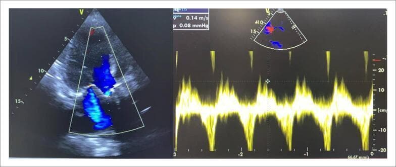 This diagnostic image consists of two panels showcasing a transthoracic echocardiogram (TTE) of a patient with severe aortic stenosis. The left panel shows a 2D apical window view with Color Doppler, highlighting turbulent, high-velocity jet flow (blue/mosaic pattern) across a calcified aortic valve. The right panel displays a Spectral Doppler waveform showing a continuous, repeating velocity pattern with a scale ranging from -20 cm/s to +20 cm/s on the y-axis. Text overlays indicate a measured velocity of 0.14 m/s and a pressure gradient of 0.08 mmHg at the specific cursor point, though the clinical context confirms a high-gradient stenotic profile (mean gradient 35 mmHg, maximum 66 mmHg) and a reduced valve area of 0.6 cm². The image demonstrates the diagnostic assessment of valvular heart disease and left ventricular function, typically used for planning Transcatheter Aortic Valve Implantation (TAVI).
