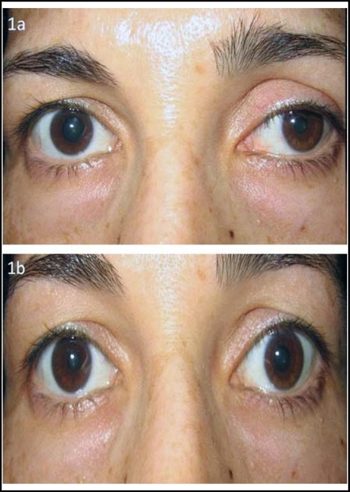 Clinical photograph showing a comparative view of a 37-year-old female patient's eyes (Figure 1a and 1b) demonstrating findings characteristic of Horner syndrome and its pharmacological testing. In Figure 1a (baseline), the patient exhibits left-sided blepharoptosis (drooping of the upper eyelid) and miosis (a smaller, constricted pupil) compared to the right eye, resulting in significant anisocoria. In Figure 1b, following the topical instillation of apraclonidine (0.5%), there is a visible reversal of these signs: the left eyelid ptosis has resolved, and the left pupil has dilated while the right pupil has slightly constricted (reversal of anisocoria). This 'apraclonidine test' result is diagnostic for Horner syndrome, reflecting the hypersensitivity of the denervated dilator muscle to alpha-adrenergic stimulation. This image is medically significant for illustrating the clinical presentation of sympathetic nerve pathway disruption and the objective results of diagnostic pupil testing in neuro-ophthalmology.