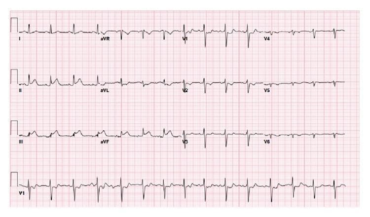 This diagnostic image is a 12-lead electrocardiogram (ECG) demonstrating an acute inferior ST-elevation myocardial infarction (STEMI). The tracing reveals significant convex ST-segment elevation in the inferior leads (II, III, and aVF), characteristic of an injury pattern often involving the right coronary artery or left circumflex artery. Accompanying these findings are prominent reciprocal ST-segment depressions in the anterior precordial leads (V1 through V6) and high lateral lead aVL. The rhythm appears to be a normal sinus rhythm with a regular rate. No significant ST-segment deviations are noted in leads I and aVR. This ECG serves as a classic educational example of an inferior STEMI with reciprocal changes, illustrating the electrical changes associated with acute transmural myocardial ischemia in the inferior wall of the heart.