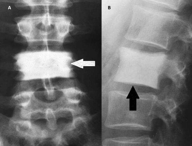 This diagnostic image consists of two radiographic views of the human spine demonstrating the 'ivory vertebra' sign. Image A is an anteroposterior (AP) X-ray showing a single vertebral body (indicated by a white arrow) with a diffuse, homogeneous increase in radiopacity, appearing significantly denser and whiter than the adjacent vertebrae above and below. Image B is a lateral X-ray of the lumbar spine where a black arrow points to a vertebral body exhibiting similar dense, white sclerosis throughout its structure. The affected vertebra in both views maintains its basic height and shape, though it shows a slight squared-off appearance of the endplates. This radiological finding is an important diagnostic indicator for several conditions, including osteoblastic metastases (commonly from prostate or breast cancer), Paget's disease of the bone, Hodgkin lymphoma, and occasionally chronic osteomyelitis. The preservation of the vertebral size and the uniform nature of the density are key educational features for differentiating ivory vertebra from compression fractures or other sclerotic bone lesions.