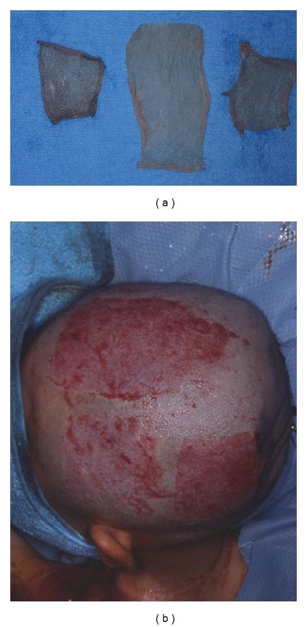 A two-part clinical photograph illustrating split-thickness skin graft (STSG) harvesting. Image (a) displays three harvested skin grafts of approximately 350 μm thickness resting on a blue surgical drape. The grafts exhibit a translucent, pale appearance with visible dermal patterning and irregular edges. Image (b) shows the donor site on a shaved human scalp immediately following the procedure. The harvested areas appear as raw, erythematous, rectangular patches with punctate bleeding, characteristic of a split-thickness donor site where the dermal papillae are exposed. The use of the hair-bearing scalp as a donor site is demonstrated, an approach utilized to facilitate rapid re-epithelialization via resident hair follicles and to conceal subsequent scarring. This visual material is intended for surgical education regarding dermatologic reconstruction, specifically focusing on graft harvesting techniques and donor site management in plastic and reconstructive surgery.