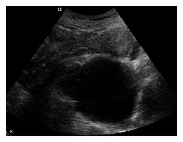A sagittal pelvic ultrasound image demonstrating a large, well-defined cystic lesion in the midline of the pelvic region. The lesion is characterized by a smooth, thin wall and anechoic internal echogenicity, consistent with a fluid-filled structure. Measuring approximately 7.5 x 8.5 cm, the cyst is located posterior to the uterus and is exerting significant mass effect, resulting in the anterior compression and displacement of the uterus, rectum, and bladder. The visual findings are characteristic of an anterior sacral meningocele, a clinical entity associated with sacral agenesis where the spinal subarachnoid space herniates through a defect in the anterior sacrum. The image highlights key diagnostic markers including morphology, lesion relationship to pelvic viscera, and the lack of internal solid components or septations, which is critical for differentiating congenital pelvic cysts from adnexal or ovarian pathologies.
