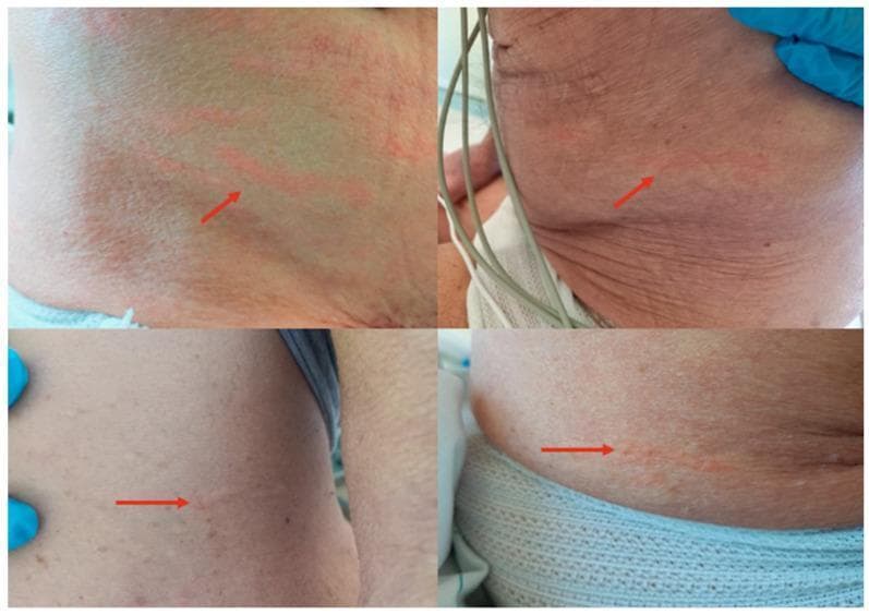 Content Type: Clinical Photograph. This four-panel composite image displays a patient's inferior abdomen and flank, showcasing pathognomonic dermatological signs of disseminated Strongyloides stercoralis hyperinfection. The primary findings are multiple, raised, erythematous, serpiginous lesions known as larva currens. These linear, wavy tracks represent the rapid cutaneous migration of filariform larvae. Red arrows highlight the specific morphology and orientation of the lesions, which appear as slightly edematous, urticarial-like streaks across the wrinkled skin of an older adult. Contextual elements include medical monitoring cables and gloved hands of healthcare providers, indicating an inpatient clinical setting. Educational Focus: Recognition of the distinctive 'racing larva' morphology and its clinical significance as a hallmark of systemic strongyloidiasis, particularly in immunosuppressed patients. Specialty: Infectious Disease, Dermatology, Tropical Medicine.