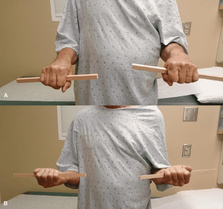 Two-panel clinical photograph (A and B) demonstrating a post-operative assessment of forearm rotation in a 62-year-old male patient following surgical intervention for a distal ulnar lesion. In both panels, the patient is shown from the waist up, wearing a clinical gown, with elbows flexed at approximately 90 degrees and tucked into the sides. Image A illustrates bilateral forearm pronation; the patient holds wooden dowels vertically, with the palms facing downward. Image B demonstrates bilateral forearm supination, with the wooden dowels rotated to a horizontal orientation and the palms facing upward. The images highlight the restoration of symmetric and intact range of motion (ROM) in the distal radioulnar joint (DRUJ) following Sauve-Kapandji reconstruction. This visual is used in orthopedic and oncology education to assess functional outcomes after limb-salvage surgery for pathologic fractures or bone tumors like low-grade chondrosarcoma.