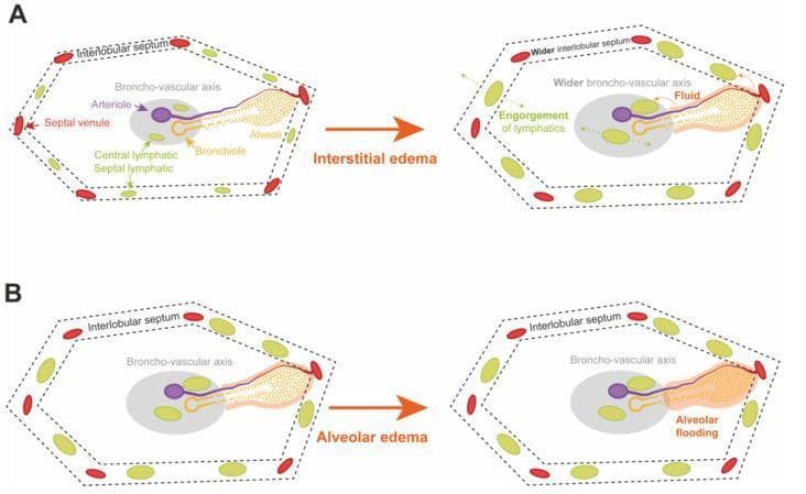 This pathophysiology diagram illustrates the development and progression of pulmonary edema within a secondary pulmonary lobule, a key concept in respiratory medicine and post-lung transplant pathology. The visual is divided into two comparative sequences. Panel A demonstrates the transition to Interstitial Edema, characterized by the widening of the interlobular septum and the broncho-vascular axis. It highlights the engorgement of both central and septal lymphatic vessels as they attempt to clear excess fluid, explaining the reticular pattern seen on CT imaging. Panel B depicts the progression to Alveolar Edema, representing high-grade primary graft dysfunction (PGD). This stage shows 'alveolar flooding,' where fluid accumulates within the alveolar spaces due to saturated lymphatic clearance and increased membrane permeability. Key anatomical structures labeled include the bronchiole, arteriole, septal venule, and lymphatic channels. This educational resource illustrates the structural basis for radiological findings like ground-glass opacities (GGO) and the macroscopic 'glassy' appearance of edematous lung tissue.