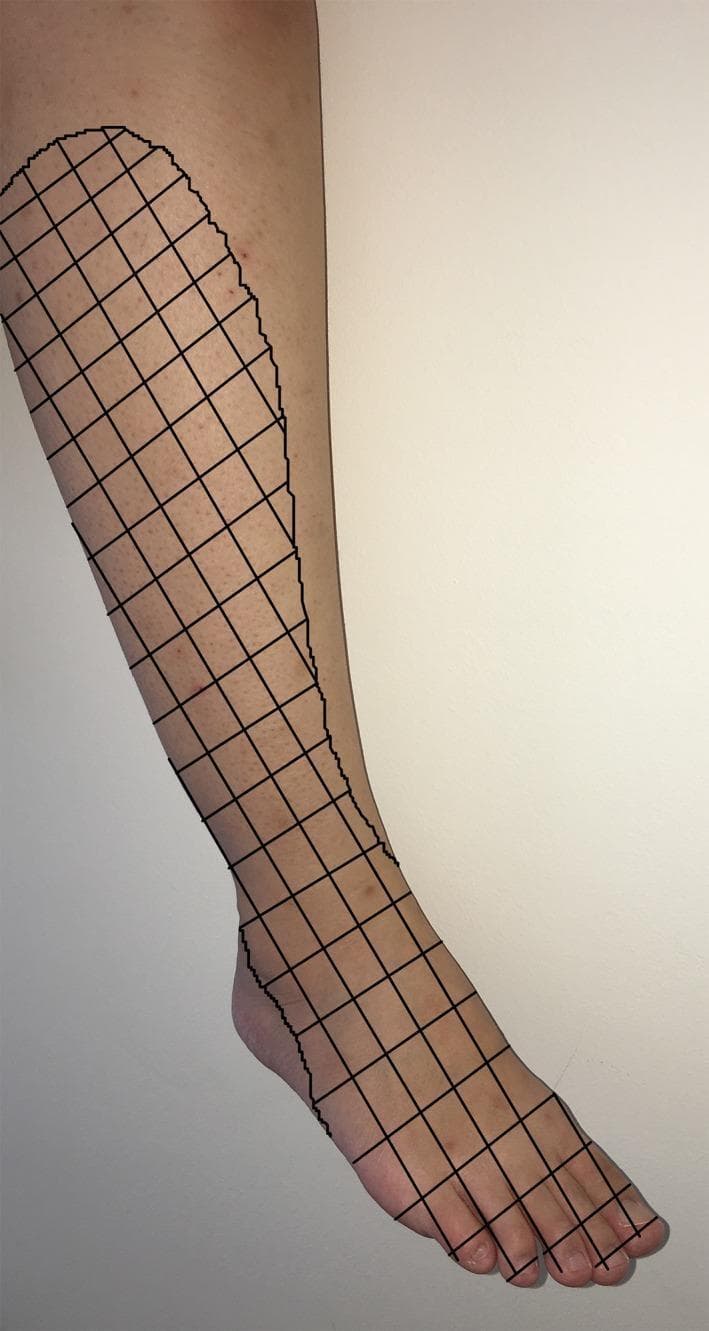 This clinical photograph with a graphical overlay illustrates the sensory distribution of the common peroneal nerve (common fibular nerve) on the right lower limb. The image displays a lateral view of a human leg and foot, with a black grid pattern demarcating the specific cutaneous regions affected by sensory loss or paresthesia. The grid covers the lateral aspect of the shin, extending distally across the anterior ankle and over the entire dorsal surface of the foot, including the phalanges. This visualization represents the typical dermatomal and peripheral nerve distribution associated with common peroneal nerve injury, often seen in clinical scenarios such as compression neuropathies, postoperative complications (e.g., following tourniquet use or arthroscopy), or direct trauma to the fibular neck. The educational focus is on identifying the anatomical boundaries of superficial and deep peroneal nerve sensory innervation, which is critical for differentiating peripheral nerve lesions from radiculopathy in neurology and orthopedics.
