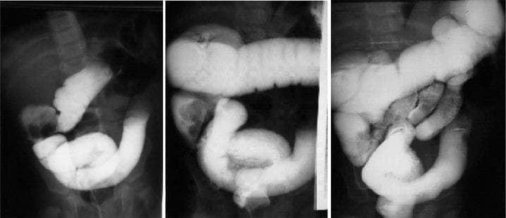 This sequence of three abdominal fluoroscopic images demonstrates a barium enema procedure being used for the therapeutic reduction of an ileocolic intussusception in a pediatric patient. In the first image, contrast highlights the classic 'coiled spring' appearance in the lower right quadrant, signifying the intussusceptum (ileum) being telescoped into the intussuscipiens (colon). As the therapeutic enema progresses in the second and third images, hydrostatic pressure from the barium contrast is shown gradually pushing the intussusceptum back towards the cecum. The series captures the proximal migration of the contrast material through the ascending and transverse colon. Educational focus is placed on recognizing the radiographic signs of intussusception reduction, including the resolution of the intussuscepted mass and the eventual free reflux of barium into the terminal ileum, which signifies a successful non-operative reduction of the bowel obstruction.