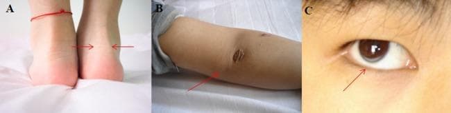 This composite clinical photograph illustrates hallmark physical manifestations of Familial Hypercholesterolemia (FH). Panel A presents a posterior view of the ankles, demonstrating bilateral Achilles tendon thickening (tendon xanthoma), indicated by red arrows. Panel B shows the extensor surface of the elbow featuring cutaneous xanthomas, which appear as raised, yellowish, irregularly shaped plaques on the skin surface. Panel C provides a close-up clinical view of the eye, revealing arcus corneae (arcus senilis), characterized by a distinct grayish-white opaque ring or arc at the periphery of the cornea. These findings are classic clinical markers for severe hyperlipidemia, often associated with genetic mutations in the LDL receptor. The image serves as an educational tool for identifying the external stigmata of lipid metabolism disorders in a pediatric or adult patient.