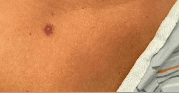 Clinical photograph of a dermatological finding on the upper right chest. The image displays a well-circumscribed, erythematous skin lesion characterized by a classic targetoid (target-like) morphology. The lesion consists of a dark red or purpuric central zone, which appears slightly raised, surrounded by a paler intermediate ring and a peripheral erythematous halo. This morphology is highly characteristic of erythema multiforme. The surrounding skin is light brown with minor scattered macules (dark spots) and appears otherwise non-inflamed. A portion of a striped hospital gown is visible in the lower right corner. The clinical context suggests an acute mucocutaneous reaction, possibly secondary to medication or infection, emphasizing the diagnostic importance of targetoid lesions in identifying hypersensitivity syndromes like Erythema Multiforme, Stevens-Johnson Syndrome (SJS), or Toxic Epidermal Necrolysis (TEN).