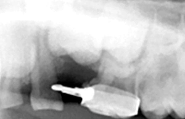 This diagnostic image is a periapical radiograph of the mandibular posterior region in a pediatric patient. It demonstrates a prefabricated band and loop space maintainer in situ. A highly radiopaque metallic band is seen closely adapted and cemented around the crown of the permanent mandibular first molar. Extending mesially from this band is a radiopaque wire loop that spans the edentulous space created by the extraction of a submerged primary second molar. The loop's distal end is soldered to the band, while its mesial aspect rests against the distal surface of the adjacent primary first molar to prevent mesial drift and maintain the mesiodistal arch dimension. The underlying alveolar bone in the extraction site shows normal trabecular healing. The image illustrates a common interceptive orthodontic procedure used to manage premature primary tooth loss and ensure adequate space for the eruption of the succedaneous premolar.