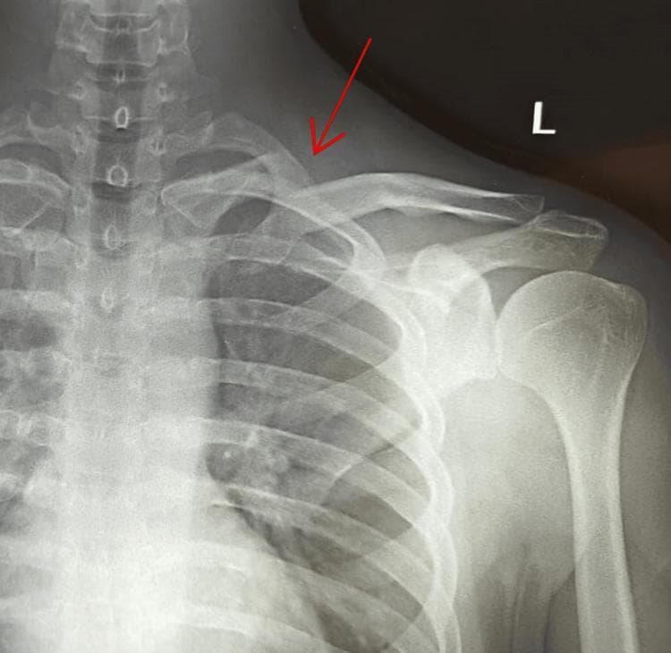 An anterior-posterior (AP) view X-ray of the left shoulder and chest, showing a displaced fracture of the medial end of the clavicle. A red arrow highlights the fracture site, where a clear discontinuity is visible. The medial fragment of the clavicle is displaced superiorly relative to its anatomical position. This finding corresponds to an Edinburgh classification type 1 B1 (displaced extra-articular) fracture. Other visible anatomical structures include the cervical vertebrae, sternum, left rib cage, scapula (including the acromion and glenoid), and the proximal humerus, all of which appear to have normal alignment and no secondary fractures. The image serves as a clinical example of orthopaedic trauma following a high-impact injury, emphasizing the need to assess for potential posterior neurovascular complications due to the proximity of the medial clavicle to the subclavian vessels.