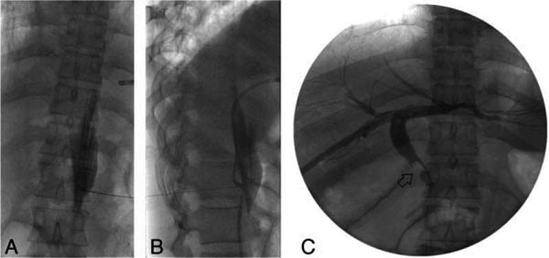 This composite of three fluoroscopy images demonstrates interventional radiology procedures in a patient with biliary obstruction. Images A and B show a celiac plexus block (CPB) using a posterior retrocrural approach at the T12-L1 level. The anteroposterior view (A) shows a bent tip needle positioned lateral to the vertebral column, while the lateral view (B) confirms the needle's trajectory and depth toward the retrocrural space, posterior to the diaphragmatic crus. Image C is a posteroanterior fluoroscopic view of a percutaneous transhepatic biliary drainage (PTBD) and tract dilatation procedure. Contrast media opacifies the intrahepatic and extrahepatic biliary tree, revealing a clear filling defect (indicated by an arrow) in the common bile duct (CBD). This defect represents a 1-cm CBD stone causing proximal obstruction. The images illustrate the combined use of anesthetic nerve blocks to manage pain during invasive hepatobiliary interventions for acute cholecystitis and choledocholithiasis.