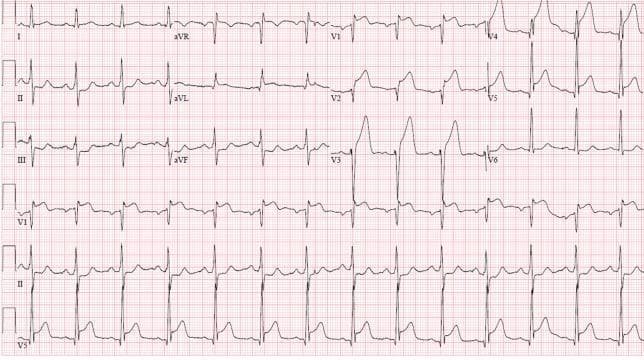 A 12-lead electrocardiogram (ECG) demonstrating an acute anterolateral ST-elevation myocardial infarction (STEMI). The tracing shows significant, convex-upward ST-segment elevation in the precordial leads (V1–V6), consistent with an anterior wall injury. Leads I and aVL also display ST-elevation, indicating lateral involvement. These changes are accompanied by hyperacute, peaked T-waves most prominent in V2 through V4. There is evidence of reciprocal ST-segment depression in the inferior leads (II, III, and aVF). The QRS complexes appear widened in the leads with maximal ST elevation. The heart rhythm is sinus. This ECG pattern is clinically significant for proximal left anterior descending (LAD) artery occlusion, necessitating urgent reperfusion therapy. The visual presentation focuses on teachable hallmarks of cardiac ischemia, including the relationship between anatomical lead distribution and corresponding vascular territories, as well as the identification of reciprocal changes in opposing leads.