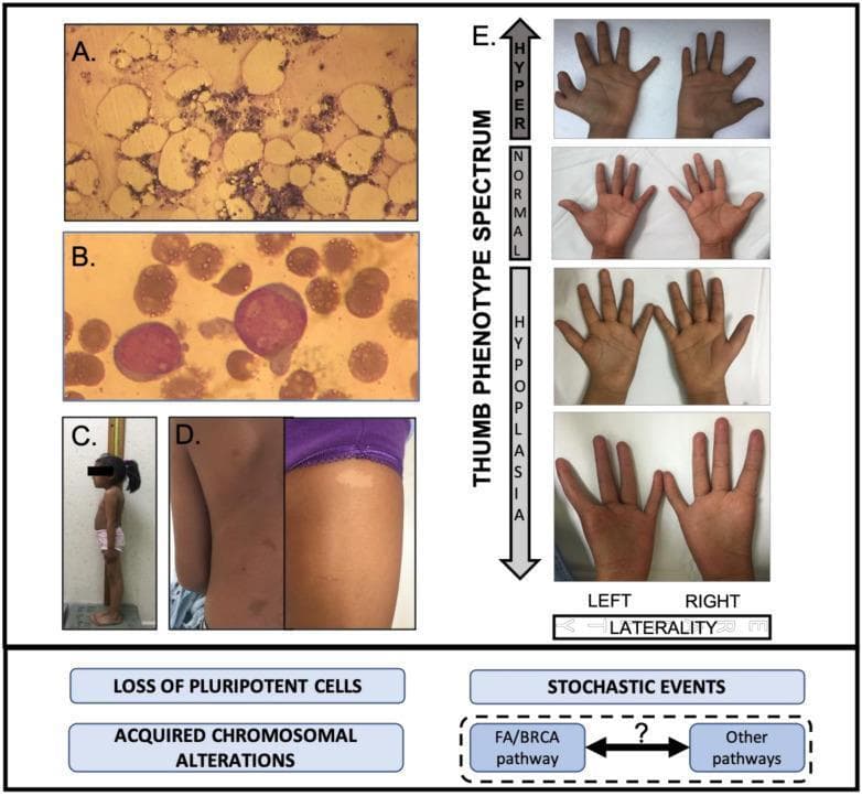 This composite educational image illustrates the multisystem clinical and pathological manifestations of Fanconi Anemia (FA), highlighting the impact of FA/BRCA pathway deficits. (A) Histological micrograph of bone marrow showing hypocellularity and attrition of hematopoietic progenitors, indicative of bone marrow failure. (B) High-power microscopy of a blood smear or marrow showing blast cells with chromosomal aberrations, representing acute myeloblastic leukemia (AML). (C) Clinical photograph demonstrating somatometric features, specifically short stature and microcephaly. (D) Clinical photographs of skin showing pigmentary abnormalities, including hyperpigmented café au lait macules (left) and hypopigmented (hypochromic) macules (right). (E) A series of clinical photographs depicting the 'Thumb Phenotype Spectrum,' ranging from hyperplasia (top) to normal, and descending into degrees of hypoplasia and aplasia (bottom), with labels for left and right hand laterality. The bottom panel provides a conceptual framework linking these features to the loss of pluripotent cells, acquired chromosomal alterations, and stochastic events within the FA/BRCA and related developmental pathways.