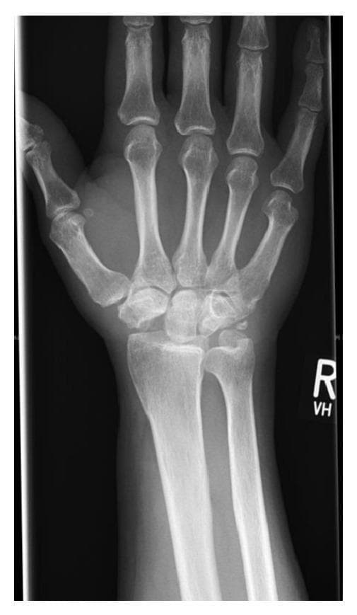 This posteroanterior (PA) X-ray of the right wrist demonstrates the postoperative appearance of a proximal row carpectomy (PRC). The primary diagnostic finding is the surgical absence of the scaphoid, lunate, and triquetrum. Consequently, the proximal carpal row is no longer present, and the capitate has migrated proximally to articulate directly with the lunate fossa of the distal radius. The newly formed radiocapitate articulation shows preserved joint space without significant degenerative changes or subchondral sclerosis. The distal radius and ulna remain intact, showing normal alignment and neutral ulnar variance. The distal carpal row (trapezium, trapezoid, capitate, and hamate) and the metacarpals appear structurally normal with maintained cortical thickness and trabecular density. This imaging is characteristic of a motion-preserving salvage procedure typically used for conditions like Stage III Kienböck's disease or scaphoid nonunion advanced collapse (SNAC), where the goal is to alleviate pain while maintaining functional wrist range of motion.