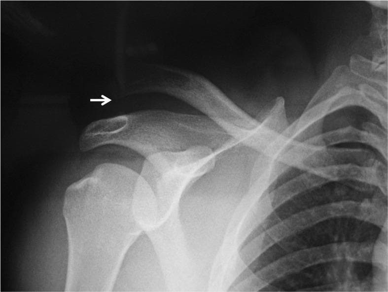 Anteroposterior (AP) radiograph of the right shoulder demonstrating a complete acromioclavicular (AC) joint separation, consistent with a Rockwood Type III injury. The image shows significant superior displacement of the distal clavicle relative to the acromion, with a white arrow highlighting the widened vertical distance between these two structures. This indicates a complete rupture of both the acromioclavicular and coracoclavicular (CC) ligaments. The glenohumeral joint is seen in a reduced state, with the humeral head properly aligned within the glenoid fossa, indicating successful reduction following a prior dislocation. Visible skeletal structures include the humerus, scapula (coracoid process, acromion, and glenoid), clavicle, and the superior ribs. No acute fractures are identified in the visualized field. This diagnostic image is used to educate on the radiographic findings of shoulder trauma, joint alignment, and the classification of AC joint injuries.