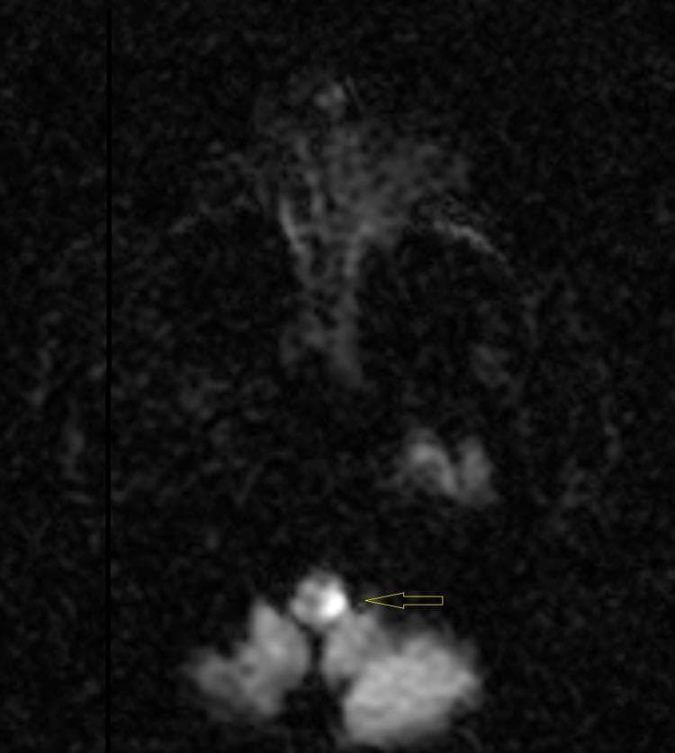 This diagnostic image is an axial Diffusion-Weighted Imaging (DWI) magnetic resonance imaging (MRI) scan of the human brain. The image shows a dark background with low signal intensity typical of this sequence, but it highlights a focal area of restricted diffusion. Specifically, there is a small, well-defined, hyperintense (bright) signal located in the left posterior medulla oblongata, indicated by a yellow arrow. This hyperintensity is roughly circular in shape and exhibits relatively sharp borders against the adjacent lower-signal brainstem parenchyma. Clinically, this finding is highly characteristic of an acute ischemic stroke in the posterior circulation, demonstrating the utility of DWI sequences in detecting early cerebral infarction that might be missed on conventional CT or early T1/T2 MRI. The image serves as an educational example of medullary stroke localization and radiographic presentation.