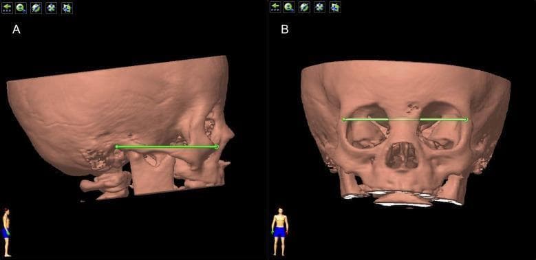 This diagnostic image displays a three-dimensional CT volume rendering of a human skull, specifically used to define standardized anatomical positioning for orbital analysis. Panel A illustrates the 'Standard Lateral Position.' A horizontal green line represents Reid’s baseline, connecting the inferior orbital margin (Orbitale point) to the superior margin of the external acoustic meatus (Auriculare point). This orientation ensures the mandibles are aligned and the cranial base is level. Panel B illustrates the 'Standard Frontal Position' after a 90-degree rotation from the lateral view. A second horizontal green line is drawn between the bilateral frontozygomatic sutures to ensure a symmetrical, standardized anterior-posterior orientation. These reference planes are critical in ophthalmology and radiology for consistent volumetric measurement of the bony orbit and localization of intraorbital pathologies, such as cysts or globe displacements. The rendering provides a clear view of the orbital rims, nasal cavity, and calvarium in a pediatric-appearing skull.