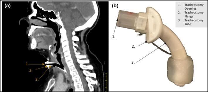 This dual-panel educational figure illustrates tracheostomy tube placement and anatomy. Panel (a) is a sagittal CT scan of the head and neck showing a tracheostomy tube in situ. The image highlights the anatomical relationship between the hardware and surrounding structures, including the anterior neck soft tissues, the tracheal lumen, and the posterior cervical spine. Numerical labels identify the tracheostomy opening (1), flange (2), and tube (3) as they penetrate the skin and enter the airway. Panel (b) provides a physical clinical photograph of the tracheostomy device, identifying the same three components: the proximal connector/opening for respiratory support, the curved stabilizing flange designed to rest against the skin, and the distal curved tube that resides within the trachea. The image serves as a reference for radiology and clinical practice to understand device orientation and its interaction with midline neck anatomy, useful for airway management training and radiation therapy planning where hardware density may affect dose distribution.