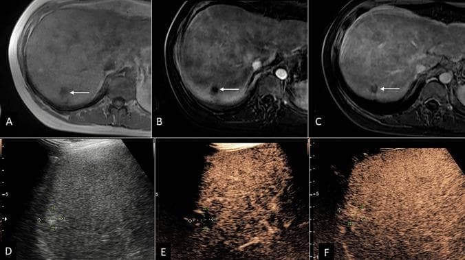 A multi-panel clinical imaging study comparing MRI and contrast-enhanced ultrasound (CEUS) for the evaluation of a hepatic hemangioma. Panels A-C display axial MRI views of the liver: (A) pre-contrast image showing a small, well-defined hypo-intense lesion in the right hepatic dome (white arrow); (B) arterial phase image exhibiting motion artifact with questionable peripheral enhancement; and (C) late phase image showing persistent hypoenhancement, leading to an initial LI-RADS 3 (LR-3) indeterminate categorization. Panels D-F present ultrasound imaging of the same 1.6 cm nodule: (D) grayscale ultrasound showing a classic hyperechoic appearance; (E) early CEUS showing peripheral interrupted arterial phase hyperenhancement (APHE); and (F) CEUS at 1 minute demonstrating persistent hyperenhancement filling the lesion. This enhancement pattern is characteristic of a benign cavernous hemangioma, allowing for definitive recategorization from MRI LR-3 to CEUS LR-1. The series illustrates the diagnostic utility of CEUS in clarifying indeterminate liver lesions found on cross-sectional CT or MRI.
