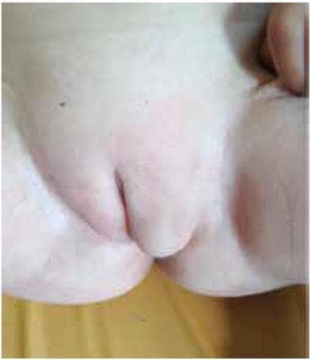 This clinical photograph shows the external genitalia of a 15-month-old patient presenting with atypical genital appearance. The visual focus is on significant asymmetry of the vulvar region. The left labium majus is markedly enlarged, elongated, and appears prolapsed, protruding downward and outward from the inguinal area. This swelling obscures the underlying anatomy and is clinically associated with the presence of a palpable gonad within the labial structure. The right labium majus appears relatively normal in size and anatomical position. There is no evidence of cliteromegaly or significant virilization visible in this frame. The skin across the region is intact with uniform pigmentation, except for a small, dark nevus on the upper left inguinal region. This image is used to demonstrate the clinical manifestation of 5-alpha-reductase type 2 deficiency (5αRD2), where genetically male individuals (46,XY or 47,XXY) may present with female-typical external genitalia and inguinal gonads.