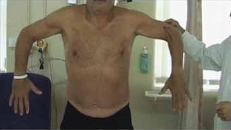 This clinical photograph demonstrates the procedural positioning for the lateral Jobe test, a physical examination maneuver used in orthopedic assessment of the rotator cuff. The patient is shown from the front with both shoulders abducted to 90 degrees in the coronal plane. The elbows are flexed to 90 degrees, and the shoulders are internally rotated such that the forearms and fingers are oriented inferiorly toward the ground, with the thumbs pointing medially toward the midline. A clinician in a white medical coat is visible on the right, applying an inferiorly directed force to the distal humerus to test for pain or weakness. This test is specifically designed to assess for pathology such as supraspinatus tendon tears or impingement. The background shows a clinical setting including a examination chair and wall-mounted diagnostic equipment.