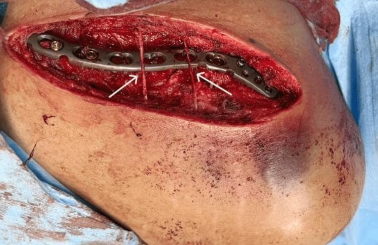 This clinical photograph is an intraoperative view of a clavicle fracture fixation. The image depicts a superior surgical approach with a sabre-shaped incision, exposing the underlying musculoskeletal anatomy of the shoulder region. A 3.5-mm precontoured metallic locking compression plate (LCP) is visible, securely fixed to the bone with multiple cortical and locking screws. A key educational feature of this image is the demonstration of fine surgical dissection to preserve neurovascular structures; specifically, two branches of the supraclavicular nerves are identified by white arrows as they cross superficially over the hardware and surgical site. The surrounding field shows mobilized skin and subcutaneous tissue with areas of ecchymosis, consistent with acute trauma. This visual serves as a primary example of orthopedic internal fixation techniques and the importance of peripheral nerve preservation during upper extremity surgery. It is intended for medical students and orthopedic residents to understand surgical anatomy, hardware placement, and nerve-sparing protocols in trauma surgery.