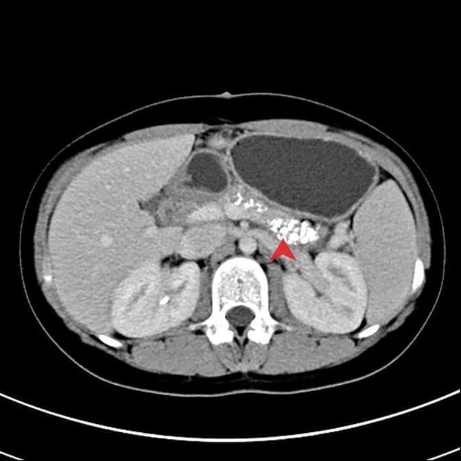 This diagnostic axial CT scan of the abdomen illustrates classic radiological findings of chronic pancreatitis. The image reveals numerous punctate, high-density areas representing parenchymal calcifications within the pancreas. A red arrow specifically highlights a dense cluster of these calcifications located in the head and neck region of the pancreas, anterior to the vertebral column. Surrounding anatomical structures include the liver in the right upper quadrant, the fluid-filled stomach positioned superiorly, the spleen, and both kidneys visualized posteriorly. The presence of extensive diffuse calcifications within the pancreatic parenchyma is a pathognomonic sign for end-stage chronic pancreatitis. This clinical imaging is essential for students and clinicians studying gastroenterology and radiology to identify permanent structural changes in the pancreas resulting from chronic inflammatory processes.