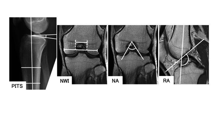 This composite diagnostic image illustrates anatomical measurement protocols for knee morphology assessment, likely for evaluating risk factors in ACL injuries. The image consists of four panels: (1) PITS (Posterior-Inferior Tibial Slope): A lateral radiograph of the proximal tibia and distal femur showing the angle between the tibial longitudinal axis and the medial tibial plateau slope. (2) NWI (Notch Width Index): A coronal MRI slice at the distal femur demonstrating the ratio of the intercondylar notch width to the total bicondylar width. (3) NA (Notch Angle): A coronal MRI slice showing the angle formed by the intercondylar notch aperture. (4) RA (Roof Inclination Angle): A midsagittal MRI slice depicting the obtuse angle between the Blumensaat line (intercondylar roof) and the longitudinal axis of the knee. These measurements are clinical indicators for femoral notch stenosis and tibial slope steepness, which are critical in orthopedic biomechanics and ligamentous injury analysis.