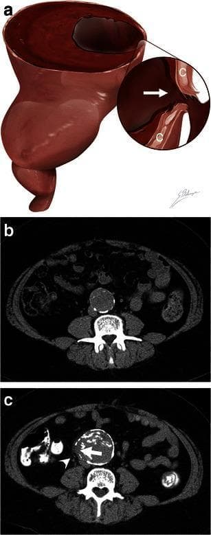 This educational composite focuses on the radiological markers of abdominal aortic aneurysm (AAA) rupture. Figure (a) is a pathophysiology diagram illustrating a focal discontinuity (arrow) in the calcified intima walls (C), which signifies a rupture site. Figures (b) and (c) provide a clinical comparison using axial unenhanced CT images of the same patient over a four-year interval. Image (b) shows the baseline state: an asymptomatic 4.2 cm AAA with intact, circumferential calcified walls appearing as a continuous hyperdense ring. Image (c) demonstrates progression to rupture, with the AAA enlarging to 5.7 cm. Key diagnostic signs of rupture are highlighted: a 1 cm focal gap or discontinuity in the calcification (white arrow) and associated periaortic fat infiltration/stranding (white arrowhead) indicating hemorrhage or inflammation into the surrounding retroperitoneal space. This comparison illustrates the importance of monitoring aneurysm diameter and wall integrity, specifically the 'focal wall discontinuity sign' in the context of acute lumbar pain.