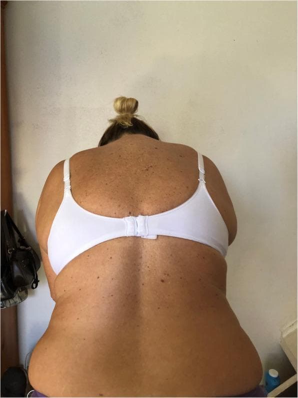 Clinical photograph demonstrating a posterior view of a patient performing the Adams Forward Bend Test, a clinical screening tool for scoliosis. The patient is leaning forward at the waist, which accentuates truncal asymmetry. The image clearly shows a prominent right-sided thoracic rib hump, where the ribs on the convex side of the spinal curvature protrude posteriorly due to vertebral rotation. This results in a noticeable dorsal tilt and uneven contour of the back compared to the contralateral side. Additional findings include asymmetrical shoulder heights and uneven soft tissue folds at the waistline. The photograph serves to illustrate the physical manifestation of structural scoliosis, highlighting how forward flexion makes rotational spinal deformities more visible to the clinician. The skin also displays numerous benign-appearing melanocytic nevi across the dorsal surface, though these are secondary to the primary orthopedic assessment.