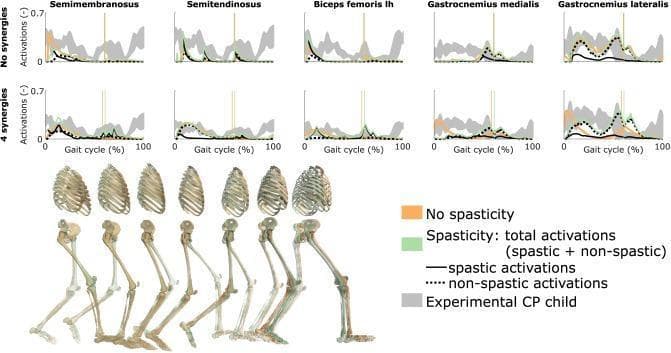 This medical infographic presents a comparative analysis of muscle activation patterns during the human gait cycle in a child with cerebral palsy (CP). The visual features a series of line graphs organized by two motor control conditions: 'No synergies' and '4 synergies.' Five specific muscles are analyzed across a 100% gait cycle: Semimembranosus, Semitendinosus, Biceps femoris long head (lh), Gastrocnemius medialis, and Gastrocnemius lateralis.
Each plot compares predictive simulation data against experimental results (shaded gray area, representing mean ± 2 SD). The simulation data differentiates between 'No spasticity' (orange), 'Spasticity: total activations' (green), 'spastic activations' (solid black), and 'non-spastic activations' (dotted black). Vertical lines denote the transition from stance to swing phase. Below the data plots, a sequential musculoskeletal diagram illustrates the right leg's progression from heel strike through the gait cycle. This educational material demonstrates the influence of spasticity and reduced neuromuscular complexity on muscle recruitment and gait mechanics in pediatric CP research.