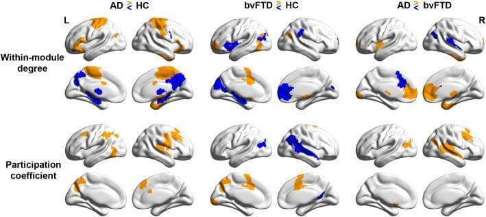 This diagnostic comparison chart utilizes brain surface plots derived from functional MRI (fMRI) data to visualize network-specific topological changes in Alzheimer’s disease (AD) and behavioral variant frontotemporal dementia (bvFTD) compared to healthy controls (HC). The image displays two primary graph theoretical metrics: Within-module degree (top rows), indicating intra-network connectedness, and Participation coefficient (bottom rows), representing inter-network distinctiveness (segregation).
The cortical maps use a color-coded scale where orange denotes significant increases and blue denotes significant decreases (p < 0.05). In AD patients vs. HC, there is a prominent reduction in within-module degree in posterior regions like the precuneus and posterior cingulate cortex, alongside increased participation coefficients in the control and somatomotor networks, suggesting reduced network segregation. In contrast, bvFTD patients vs. HC exhibit significant connectivity decreases in frontal and insular regions within the salience/ventral attention network (SVAN). The head-to-head comparison (AD vs. bvFTD) further illustrates the divergent neurodegenerative patterns, emphasizing the posterior-dominant breakdown in AD versus the anterior/insular vulnerability in bvFTD.