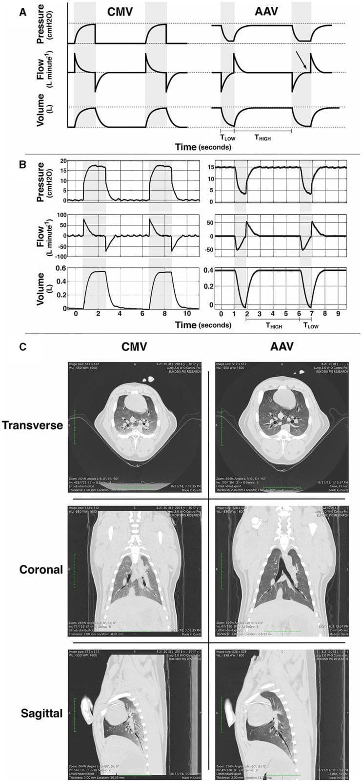 This multi-panel figure illustrates a comparative analysis of two mechanical ventilation modes: Conventional Mechanical Ventilation (CMV) and Apneustic Anesthesia Ventilation (AAV). Section A provides idealized schematic waveforms for pressure, flow, and volume over time. CMV is characterized by intermittent pressure increases from baseline, while AAV (similar to Airway Pressure Release Ventilation or APRV) maintains an elevated baseline pressure (PHIGH) for a prolonged duration (THIGH) with brief, rapid releases to a lower pressure (PLOW) during a shorter interval (TLOW). Section B displays corresponding real-time example waveforms, highlighting that AAV maintains higher lung volumes throughout the respiratory cycle. Section C presents thoracic computed tomography (CT) scans in transverse, coronal, and sagittal planes, comparing lung recruitment and aeration between modes. The AAV images demonstrate improved lung inflation and more uniform density across the parenchyma compared to CMV, where areas of increased dependent opacification suggest potential atelectasis. This resource is designed for critical care and anesthesia education, focusing on respiratory physiology, ventilator waveform analysis, and the impact of ventilation strategies on pulmonary recruitment.