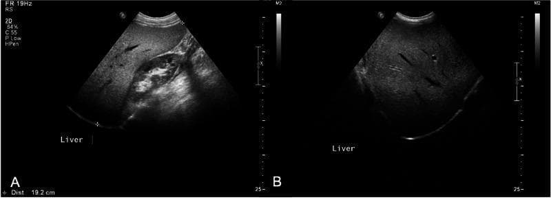 Abdominal diagnostic ultrasound images demonstrating hepatomegaly and hepatic steatosis. Image A is a longitudinal gray-scale view of the right upper quadrant showing an enlarged liver with a span measured at 19.2 cm in the midclavicular line. The liver parenchyma exhibits diffuse hyperechogenicity (bright liver) compared to the adjacent renal cortex, characteristic of fatty liver disease. The right kidney is partially visualized and appears morphologically normal. Image B is a transverse view showing the same hyperechoic pattern throughout the liver parenchyma with some visualization of hepatic vasculature. The increased echogenicity causes significant attenuation of the ultrasound beam in the deeper tissues. These findings are clinically significant for diagnosing hepatic steatosis and monitoring liver size in the context of metabolic or endocrine disorders.