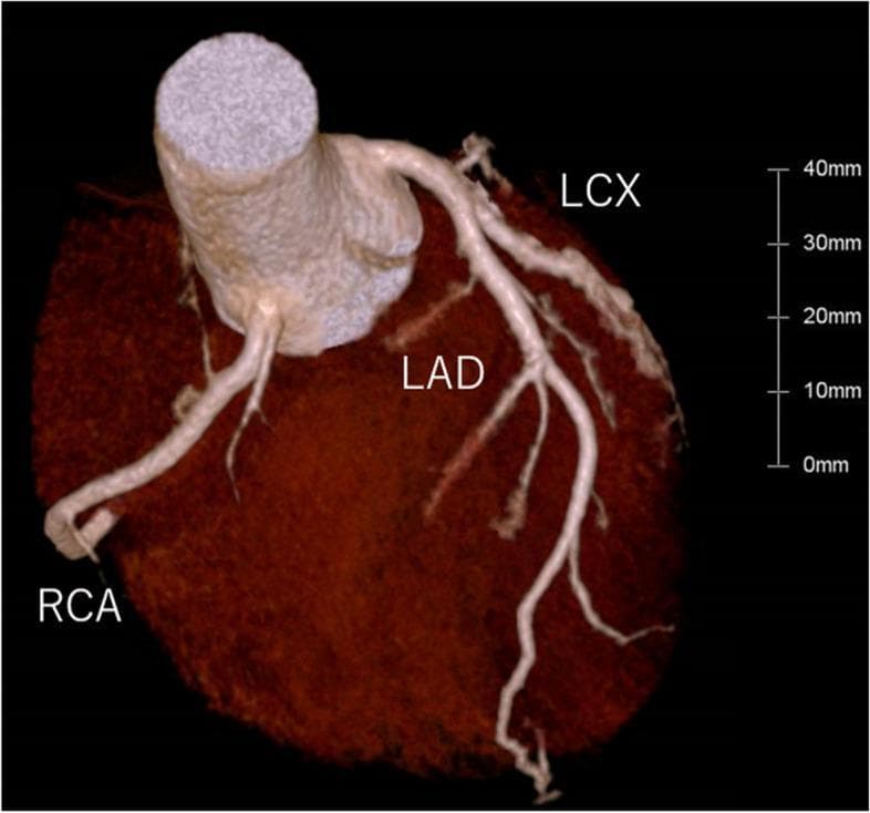 This 3D volume-rendered Computed Tomography Angiography (CTA) image provides a comprehensive visualization of the coronary arterial anatomy. The image displays the major coronary arteries originating from the ascending aorta and coursing over the epicardial surface of the heart. The Left Anterior Descending (LAD) artery is clearly visible descending along the anterior interventricular sulcus, exhibiting multiple diagonal branches. The Left Circumflex (LCX) artery is seen branching from the left main coronary artery and traveling along the left atrioventricular groove. The Right Coronary Artery (RCA) originates from the right coronary sinus and traverses the right atrioventricular groove. All visualized vessels appear patent with smooth luminal contours and no evidence of significant calcified or non-calcified atherosclerotic plaques or stenotic lesions. The myocardium is rendered in a dark, textured brown tone to provide anatomical contrast, and a 40mm scale bar is included for size reference. This diagnostic image is typical for assessing coronary artery disease (CAD) and evaluating coronary anatomy in a clinical setting.