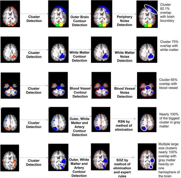 This diagnostic diagram illustrates an unsupervised independent component (IC) sorting mechanism for resting-state functional MRI (rs-fMRI), specifically designed for identifying Seizure Onset Zones (SOZ). The image is organized into a five-row flow-process chart demonstrating the automated classification of voxel clusters. The first three rows depict the 'waterfall' technique for noise purging: periphery noise (82.1% brain boundary overlap), white matter noise (75% white matter overlap), and blood vessel noise (65% vascular overlap). These are identified through sequential steps of cluster detection followed by specific contour detection (outer brain, white matter, or artery). The fourth row demonstrates the identification of Resting State Networks (RSN), characterized by the largest cluster showing nearly 100% overlap with gray matter. The final row identifies the Seizure Onset Zone (SOZ) based on multiple large-size clusters overlapping nearly 100% with gray matter, predominantly localized to one hemisphere. This algorithm aims to reduce manual IC sorting time for neurosurgeons evaluating children with drug-resistant epilepsy.
