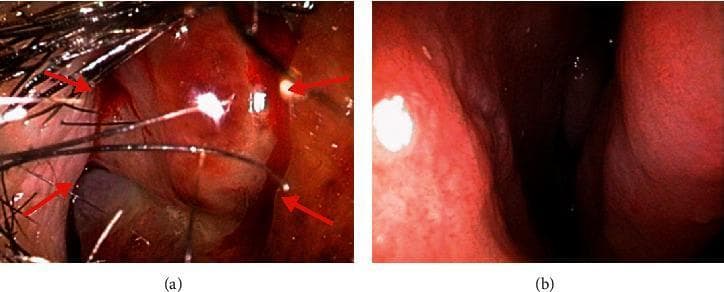 This diagnostic image consists of two side-by-side endoscopic views (a and b) of the nasal cavities, demonstrating a Comparison Chart format for clinical pathology. Panel (a) shows the right anterior nasal cavity, featuring a prominent, erythematous granulomatous mass with an irregular, cobblestone-like surface texture. Red arrows highlight the borders of the lesion, which appears highly vascularized. Nasal vibrissae (hairs) and specular reflections from the endoscope light source are visible in the foreground. In contrast, Panel (b) depicts the contralateral left nasal cavity, showing a healthy physiological state characterized by a smooth, uniform pinkish-red mucosal lining without masses or inflammation. This comparison is used in Otolaryngology to illustrate localized nasal pathology, such as infections (e.g., Mycobacterium marinum) or inflammatory conditions, and emphasizes the diagnostic utility of rhinoscopy in identifying abnormal tissue growth versus healthy anatomy.