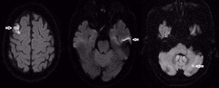 Diagnostic axial brain MRI series utilizing Diffusion-Weighted Imaging (DWI). The sequence demonstrates multiple areas of acute ischemic infarction characterized by focal hyperintense (bright) signal abnormalities. The infarcts are multifocal and involve different vascular territories. Specifically, cortical hyperintensities are visible in the bilateral frontal lobes, with the right-sided lesion appearing more extensive and irregular, following the gyral contours. An additional focal area of restricted diffusion is evident in the left cerebellar hemisphere, marked by a white arrow, representing a posterior circulation infarct. The distribution of these lesions suggests an embolic etiology or multi-territory vascular involvement. This imaging is characteristic of acute cerebral ischemia and is used clinically to localize acute infarcts and assess stroke burden in patients presenting with focal neurological deficits such as dysphagia or motor dysfunction.
