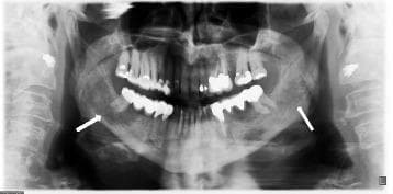 This diagnostic image is a panoramic X-ray (orthopantomogram) of the human maxillofacial region, showing the complete mandible, maxilla, and surrounding dental structures. Two white arrows indicate distinct pathological findings located bilaterally at the mandibular angles. These areas are characterized as osteolytic zones, presenting as radiolucent (darker) regions with ill-defined borders compared to the surrounding radiopaque cortical and cancellous bone. The osteolysis is observed on both the right and left sides of the lower jaw, with the right side showing more prominent involvement. Multiple dental restorations and evidence of previous dental procedures are visible across the dentition. The image serves as a clinical teaching tool for recognizing mandibular bone loss and differential diagnosis of systemic diseases manifesting in the jaw, such as sarcoidosis, osteomyelitis, or malignancy.